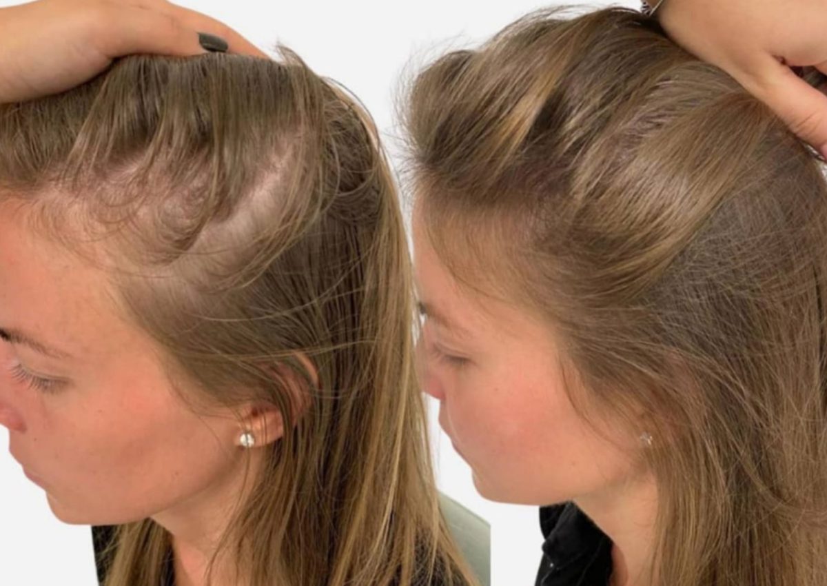 Wie man die beste Haartransplantation für Frauen bekommt